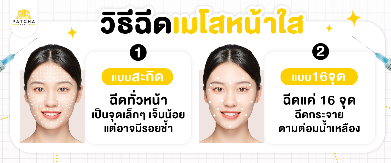 วิธีฉีดเมโสหน้าใส