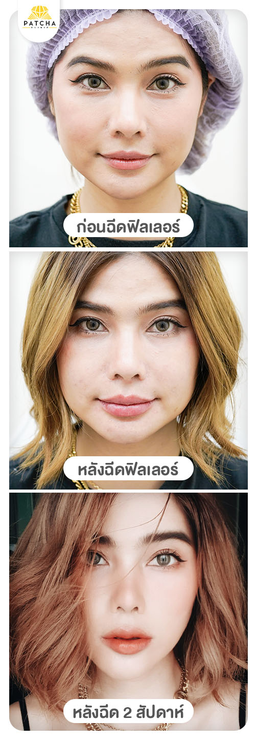 ฟิลเลอร์ปากบวมนานไหม