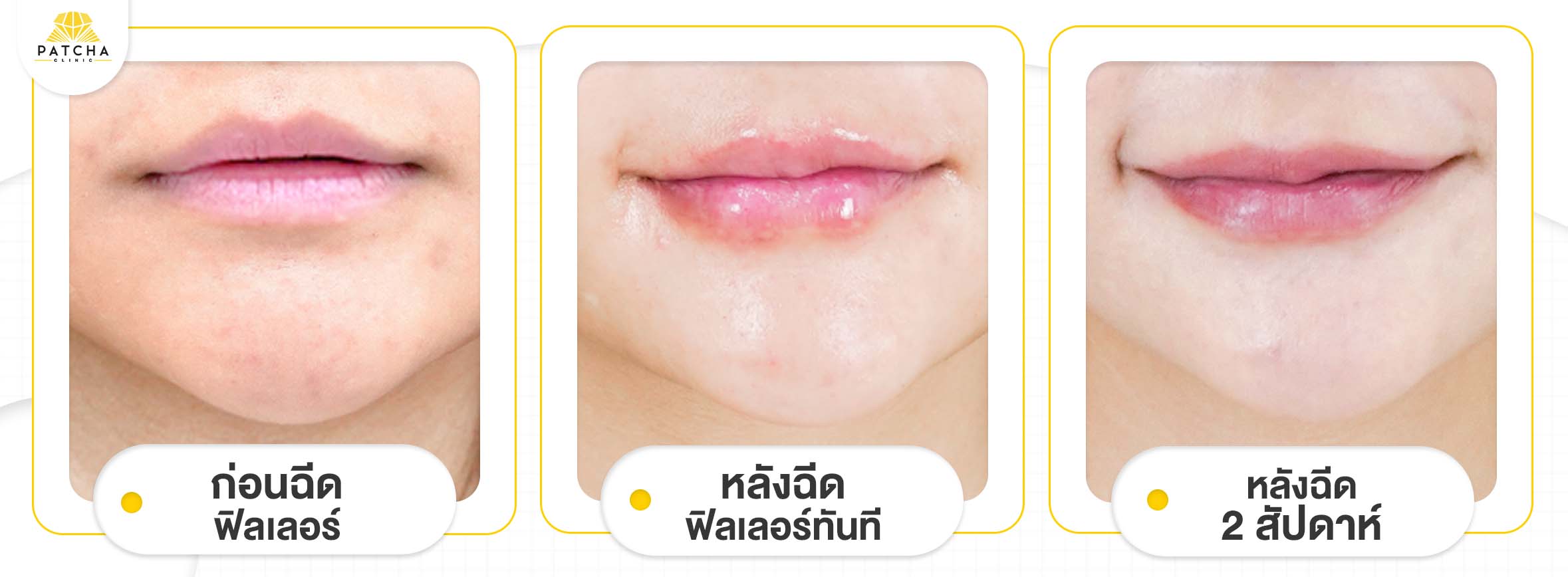 ฟิลเลอร์ปากเป็นก้อน