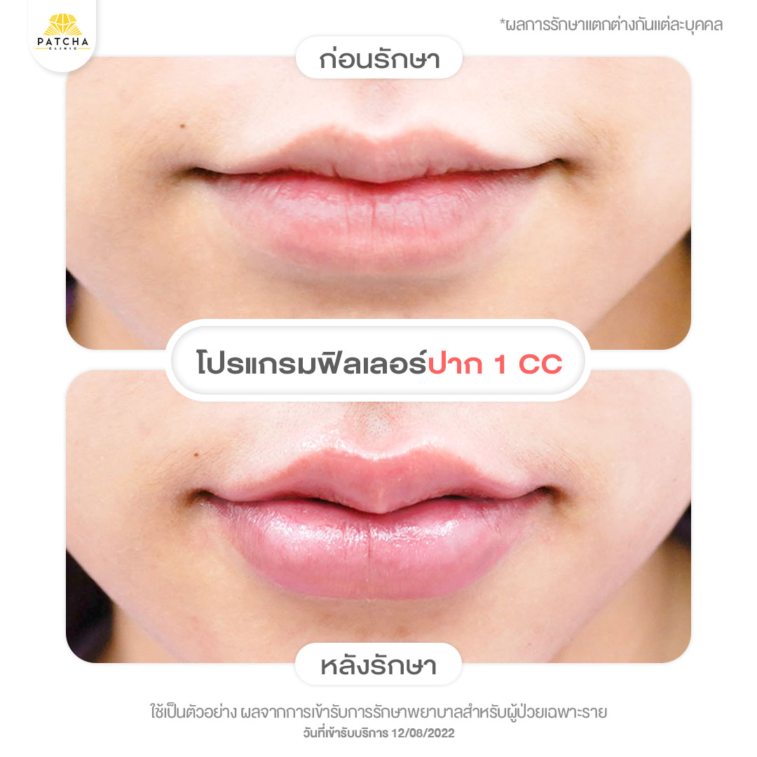 lip-filler รีวิว