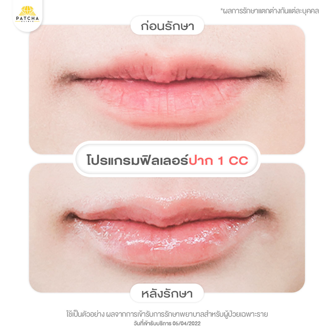 lip-filler คุณอิม