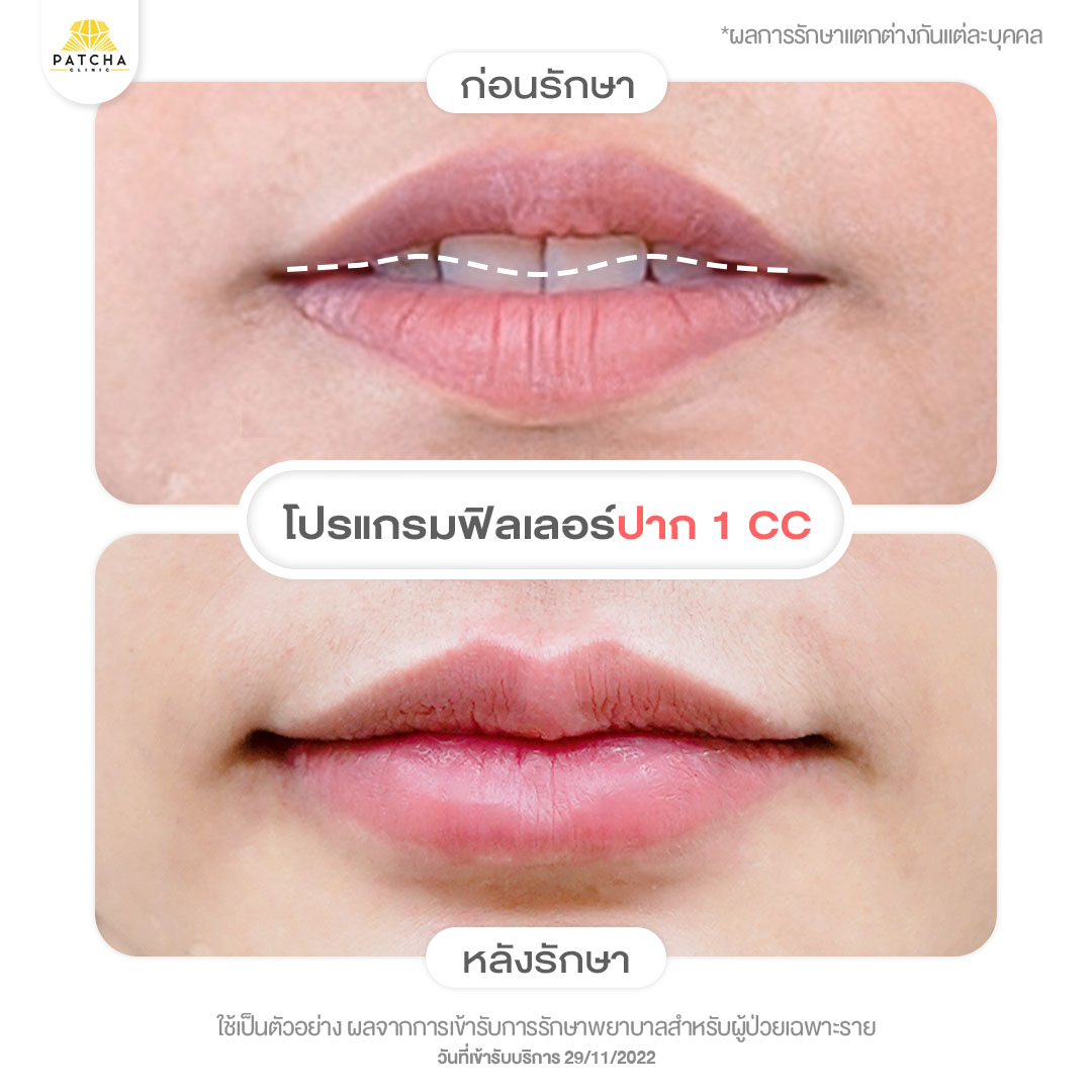 lip-filler เคสรีวิวคุณไอรีน ตัดปากมาฉีดฟิลเลอร์ปาก