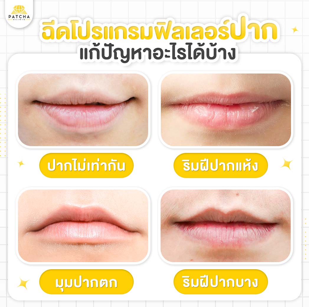 lip-filler แก้ปัญหาอะไรได้บ้าง