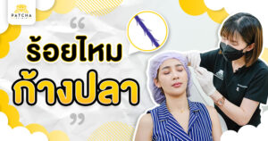 ร้อยไหมก้างปลา