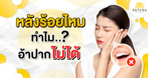 ทำไมร้อยไหมอ้าปากไม่ได้