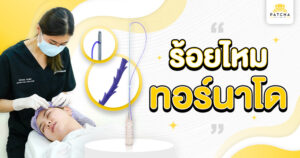 ร้อยไหมทอร์นาโด