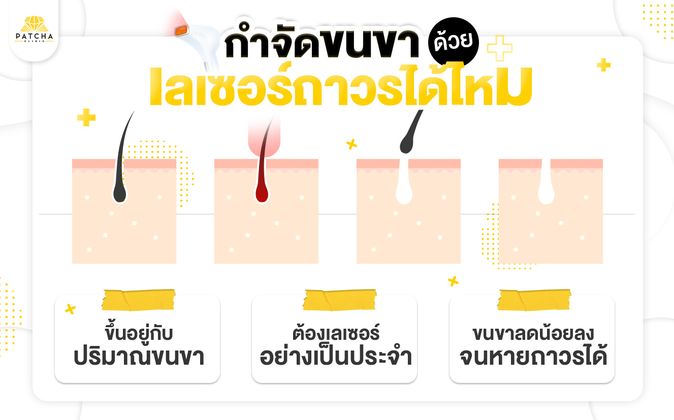 เลเซอร์ขนขาถาวรไหม
