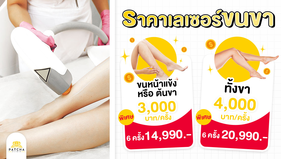 ราคาเลเซอร์ขนขา