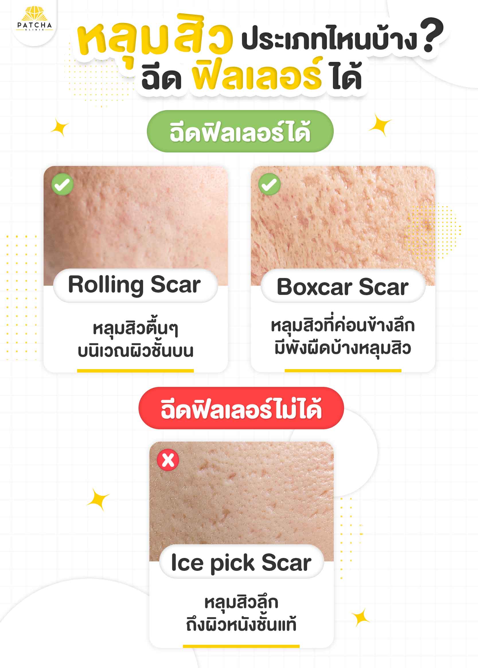 หลุมสิวแบบไหนฉีดฟิลเลอร์ได้