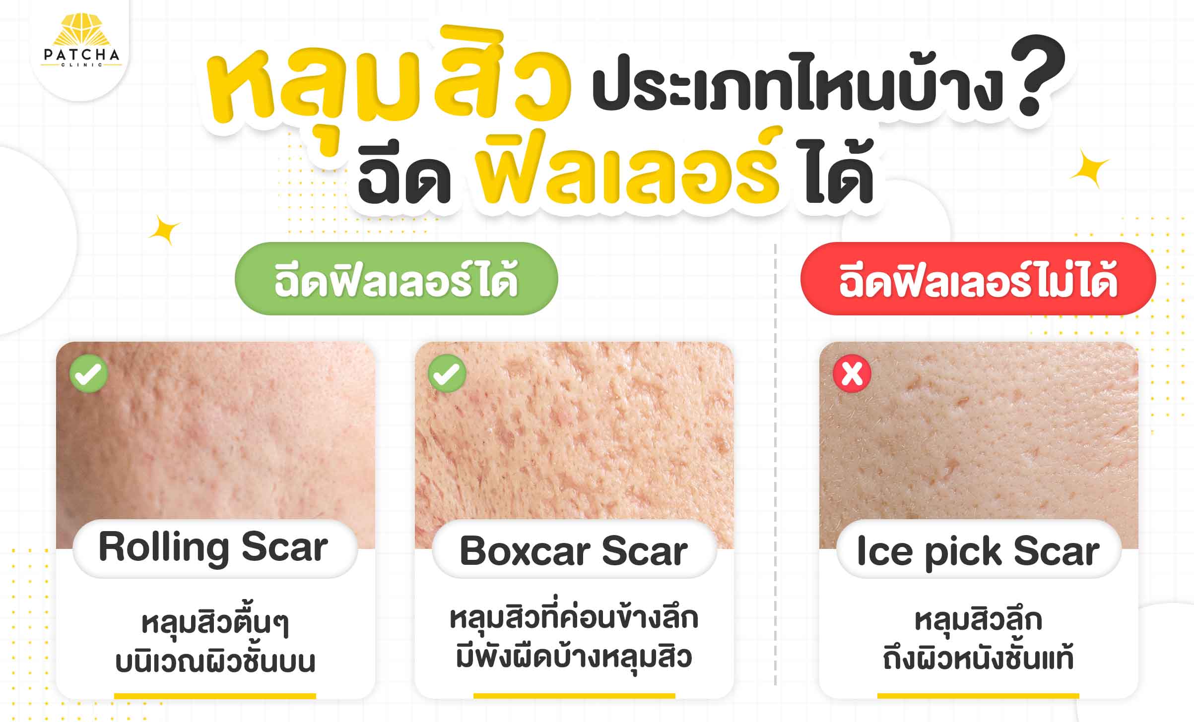 หลุมสิวแบบไหนฉีดฟิลเลอร์ได้