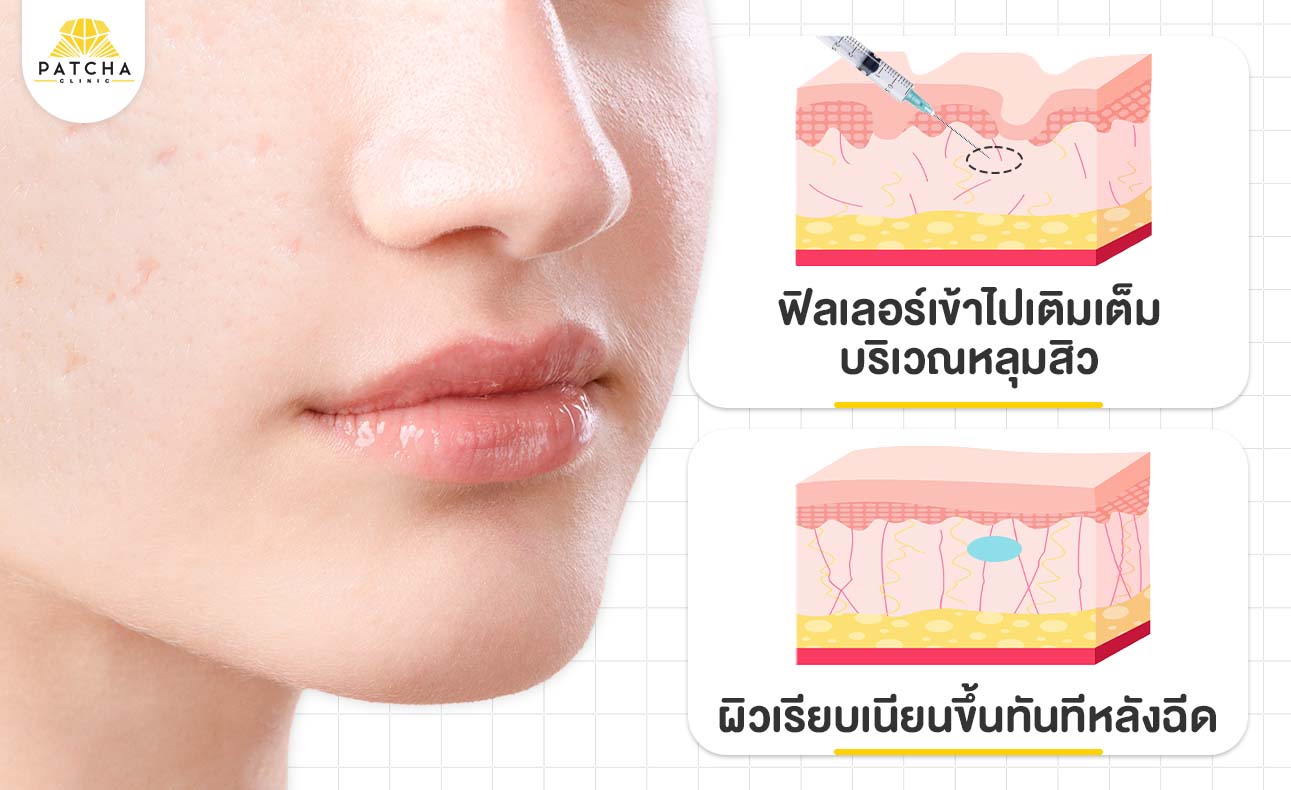ฟิลเลอร์หลุมสิวคืออะไร