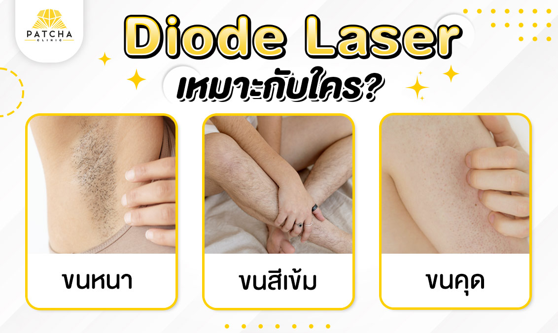 Diode laser เหมาะกับใคร