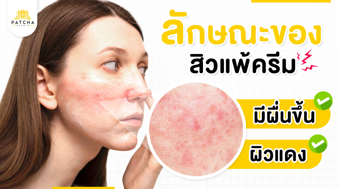 ลักษณะสิวแพ้ครีม