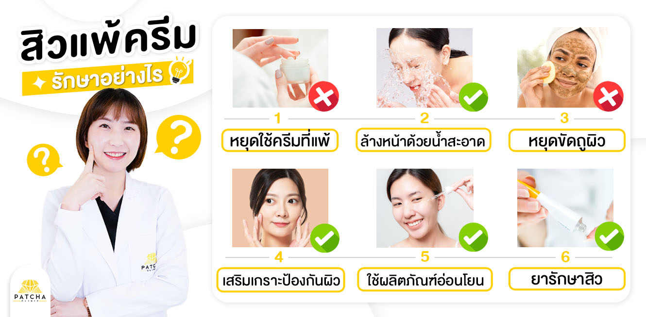 วิธีรักษาสิวแพ้ครีม