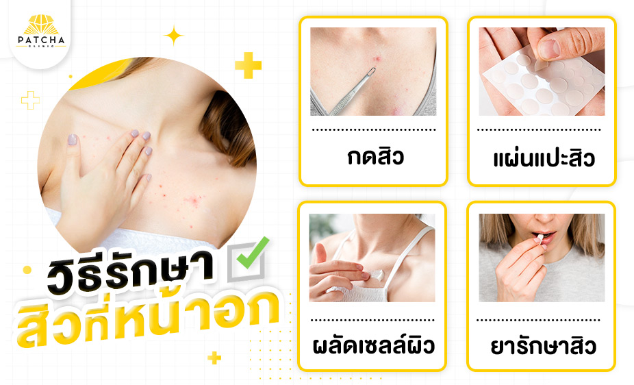 วิธีรักษาสิวที่หน้าอก