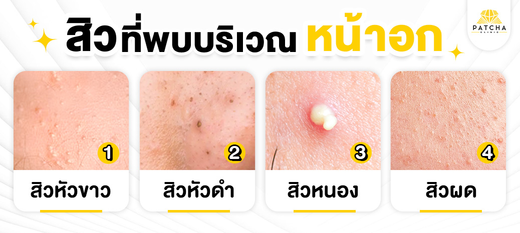 สิวที่หน้าอกมีแบบไหน