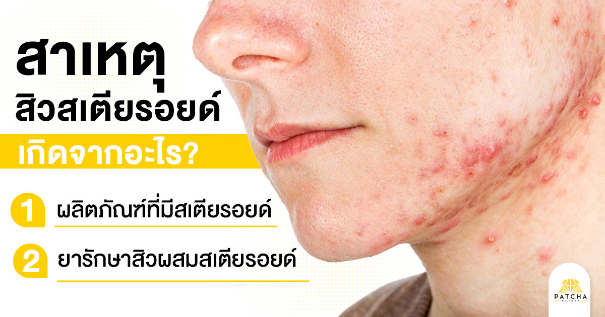 สิวสเตียรอยด์เกิดจาก