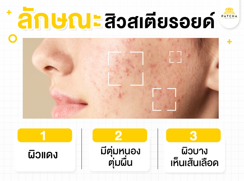 ลักษณะสิวสเตียรอยด์