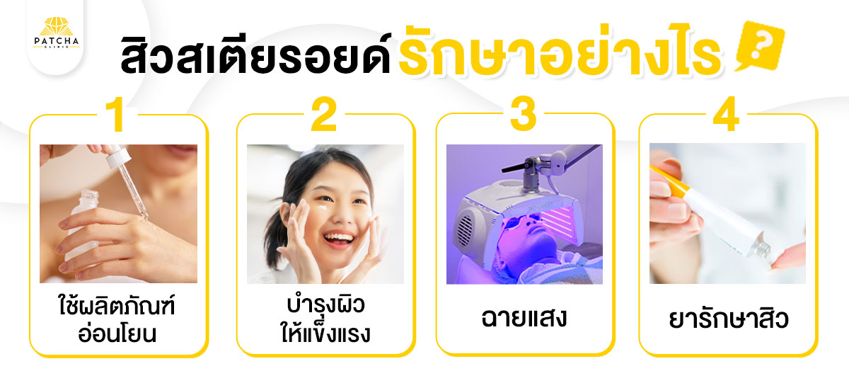 วิธีรักษาสิวสเตียรอยด์