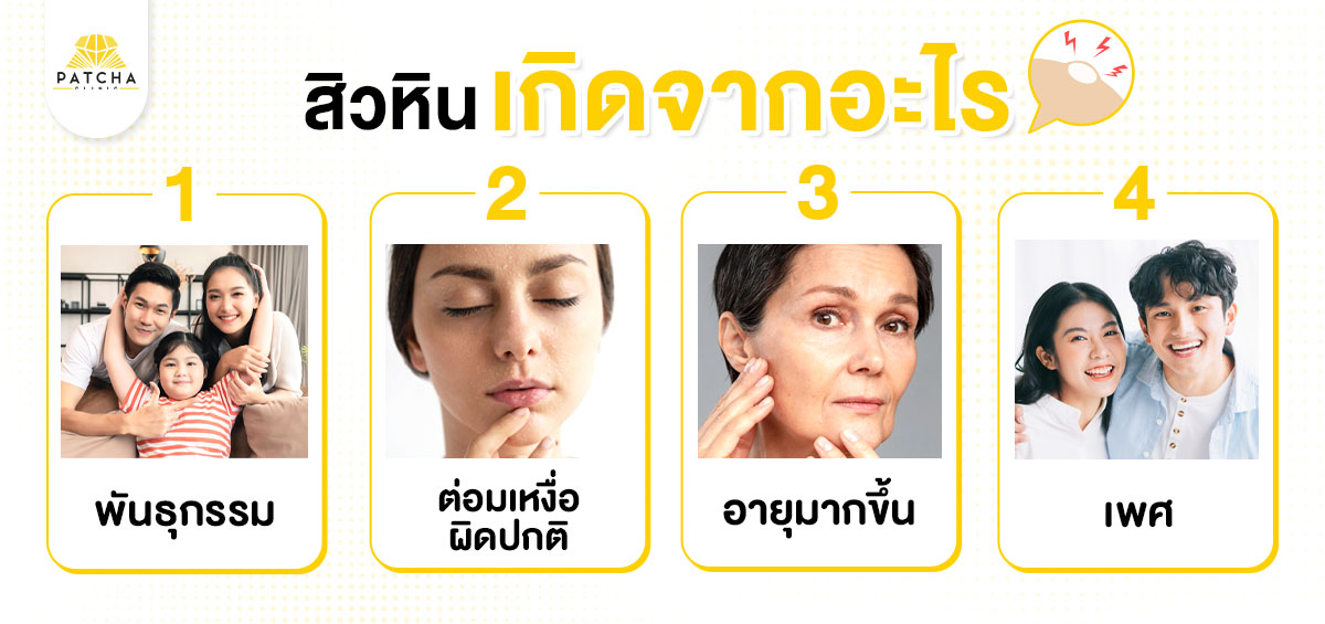 สิวหินเกิดจากอะไร