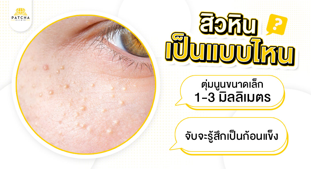 สิวหินเป็นแบบไหน