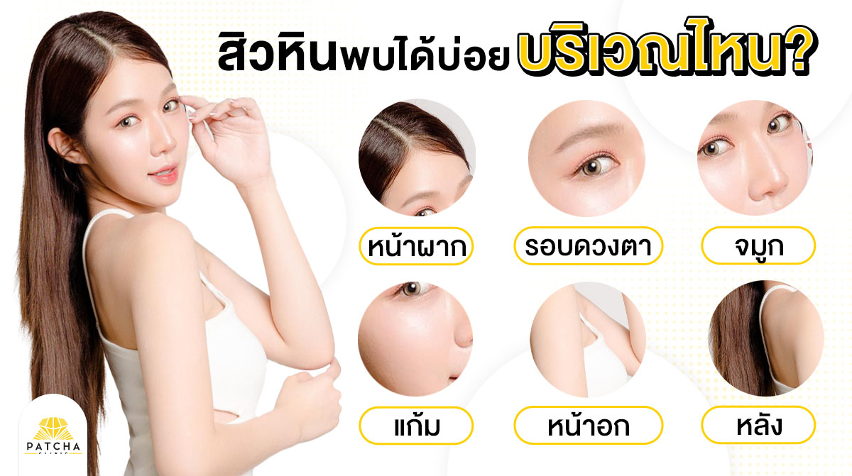 สิวหินพบบ่อยบริเวณไหน