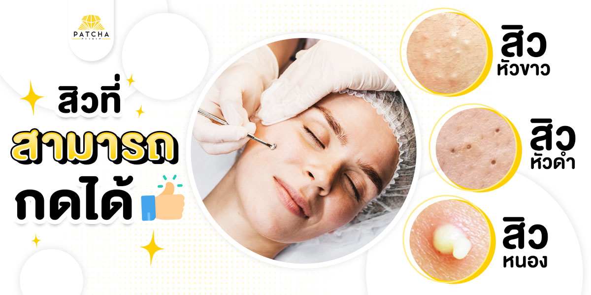 สิวที่กดได้