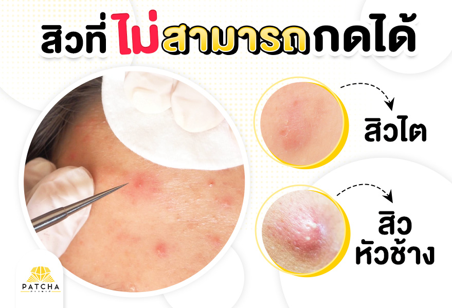 สิวที่กดไม่ได้