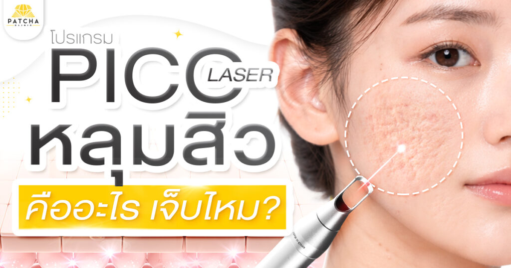 Pico หลุมสิวคืออะไร